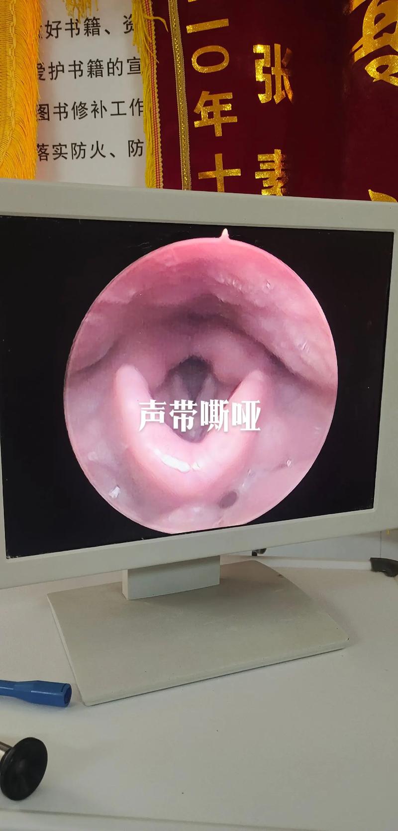 聲帶嘶啞的內窺鏡及喉鏡檢查 原理、流程與應用
