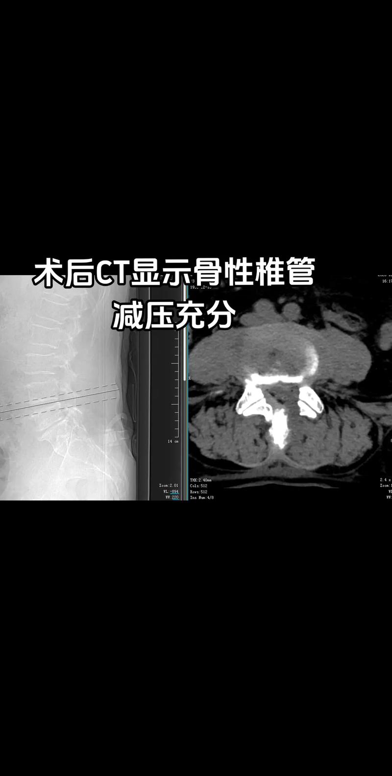 八旬老翁告別腰腿痛 UBE內鏡微創治療腰椎間盤突出合并椎管狹窄紀實