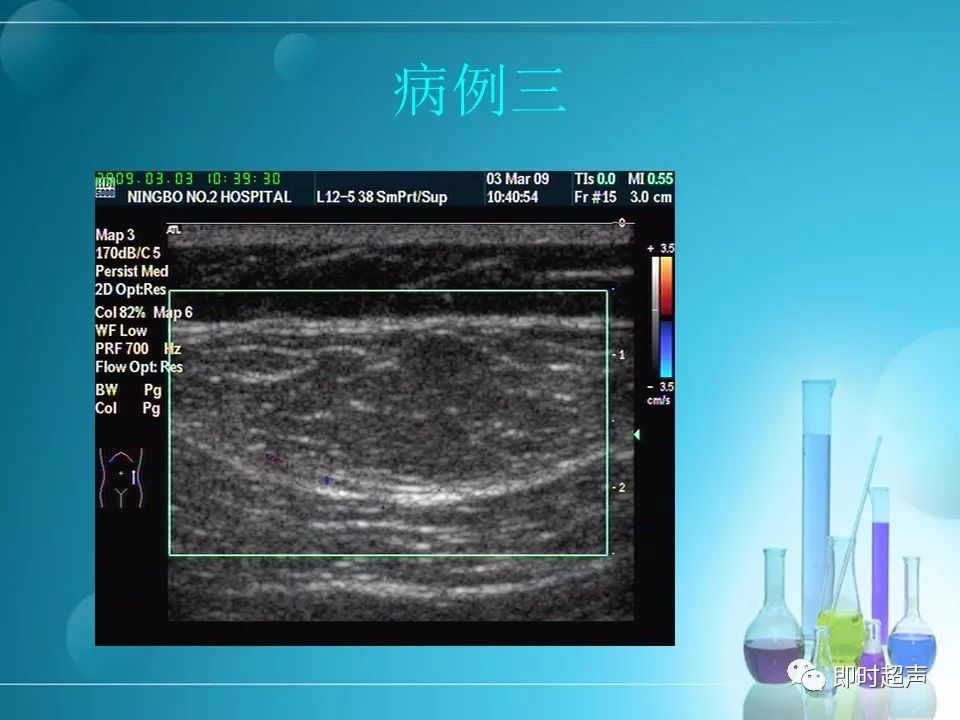 超聲內鏡下高血管化腫塊活檢困境 一份教學病例分析